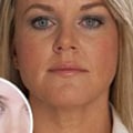 Do Fillers Change Your Face Permanently?