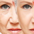 Do Fillers Slow Down Aging?