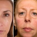 The Aging Effects of Facial Fillers