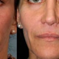 What are fillers on the face?