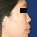 How long do permanent fillers last?