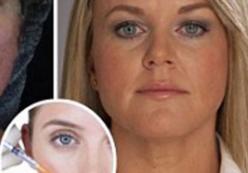 Do fillers change your face permanently?