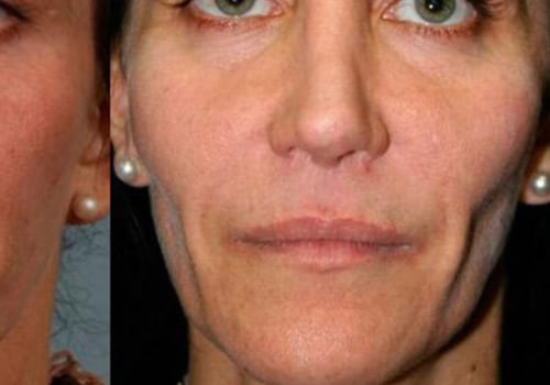 Can facial fillers be removed?