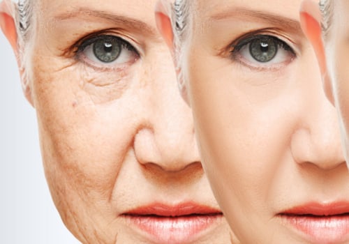 Do fillers slow down aging?