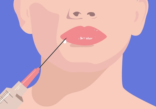 A guide to facial fillers