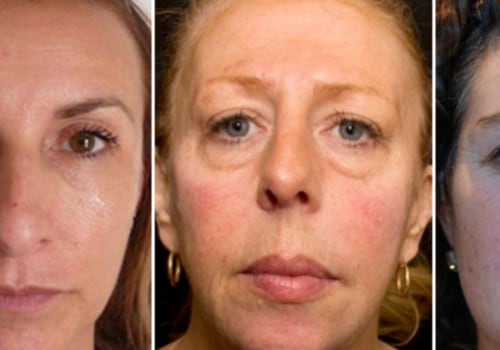 The Aging Effects of Facial Fillers
