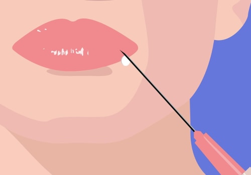 Where do you put fillers on your face?